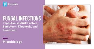 FUNGAL INFECTION – STRONG MEDICIN